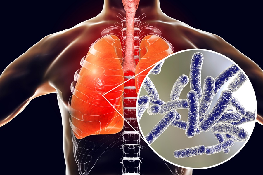 Could Legionnaires’ Disease Reach Long Island? Harlem Outbreak Raises Health Concerns Across Region